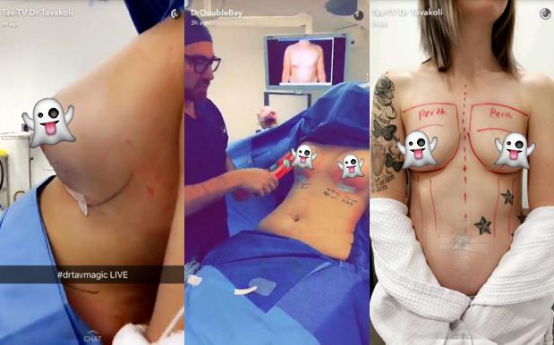 There’s An Aussie Plastic Surgeon Snapchatting Boob Jobs