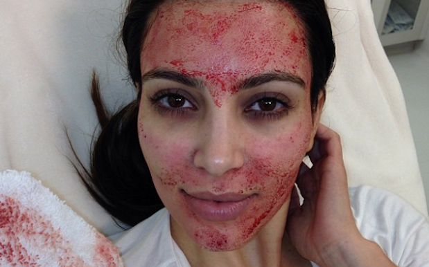 Botched Blood Facial Inspired By Kim K Allegedly Linked To 2 HIV Diagnoses
