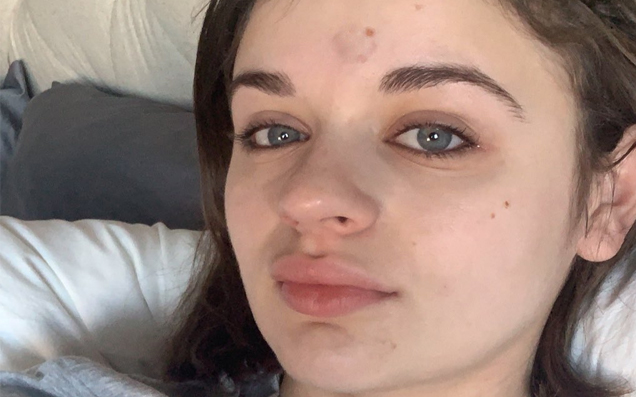 Joey King Is Fkn Loving Her Golden Globe-Shaped Shiner Courtesy Of A Clumsy Patricia Arquette