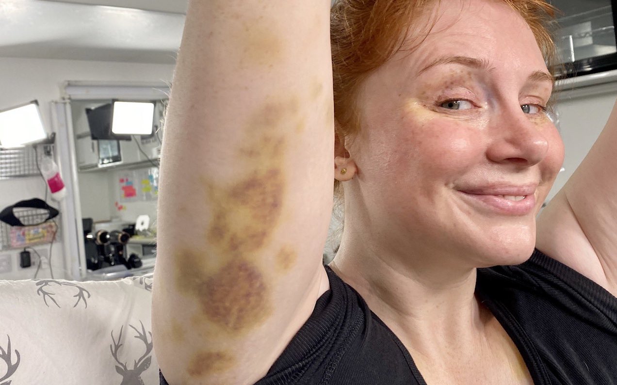Look At The T-Rex-Sized Bruises Bryce Dallas Howard Copped Filming Jurassic World 3 Stunts