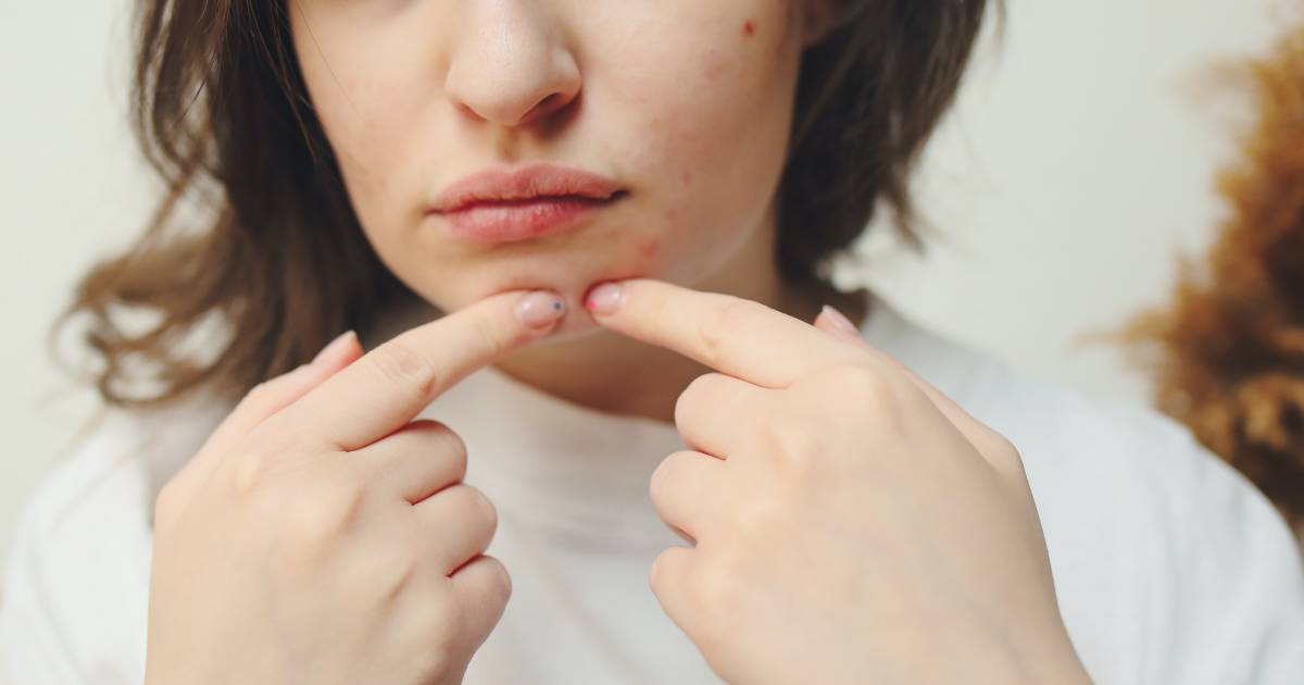 Humble Opinions: These Pimple Patches Will Actually Nix That Zit